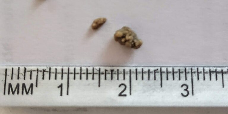 Azt hitték a tolvajok, aranyrögöket lopnak, de valójában csak veseköveket sikerült